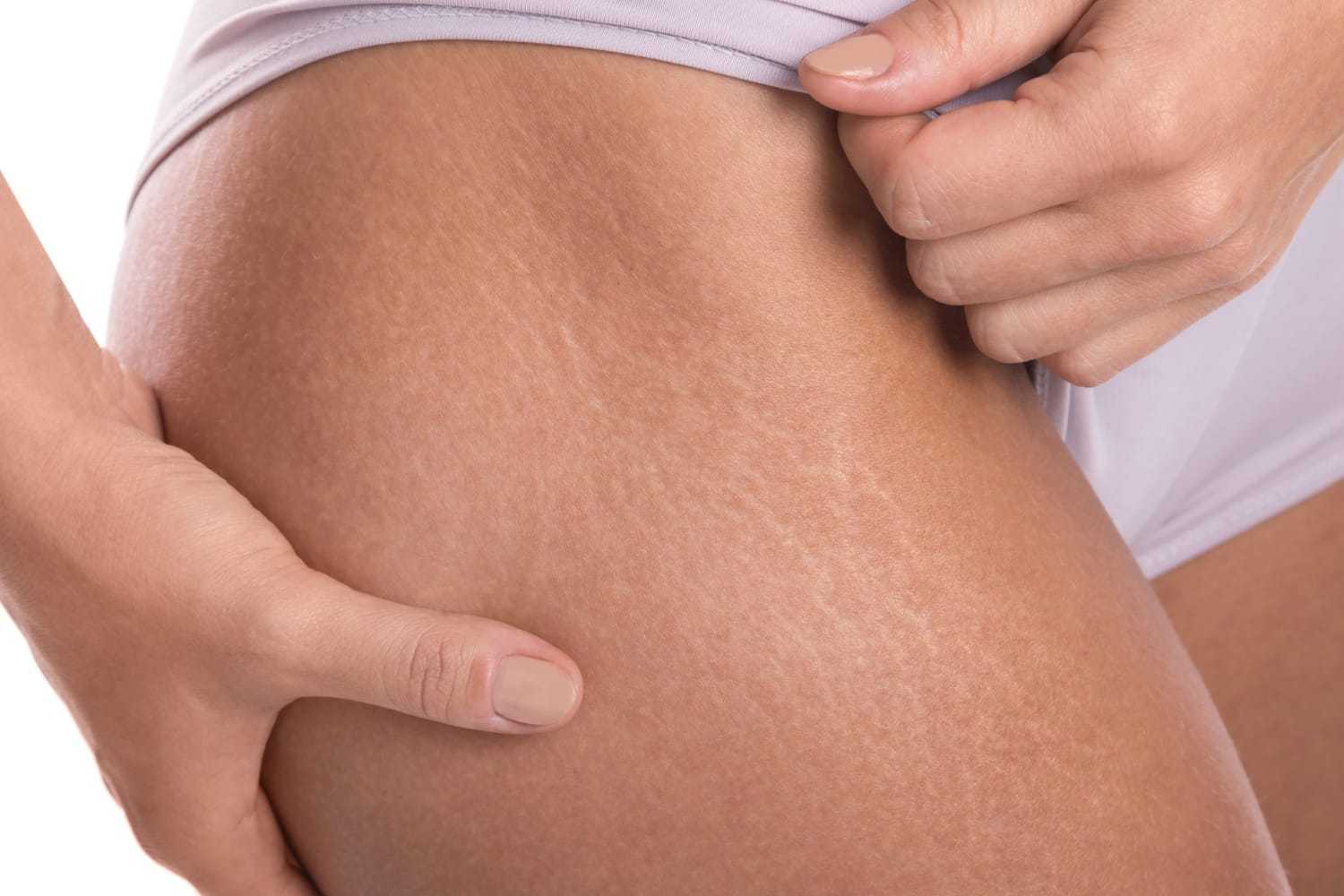 Close-up of a person's hands showing stretch marks on their thigh.