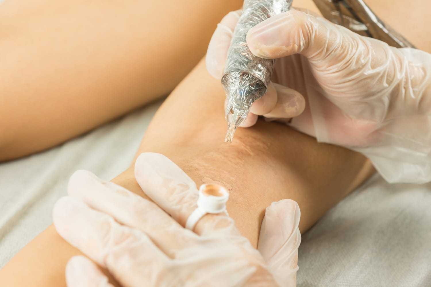 Tattoo artist working on a scarred skin area, wearing gloves for precision and safety.