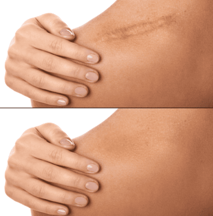 Before and after images of a treated scar on an upper arm.