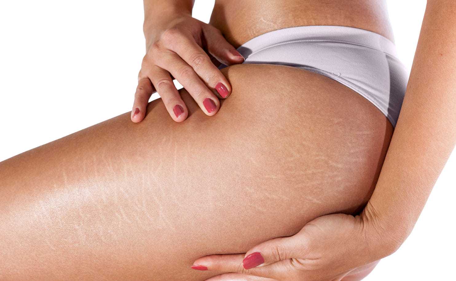 Skin with stretch marks on thigh; person applying gentle pressure with hands.